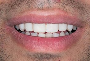 Redford Smiles | Ceramic Crowns, Sports Mouthguards and Laser Dentistry
