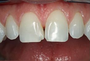 Redford Smiles | All-on-6 reg , CEREC reg  and Emergency Treatment